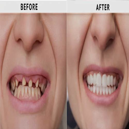 Smile Makeover 1