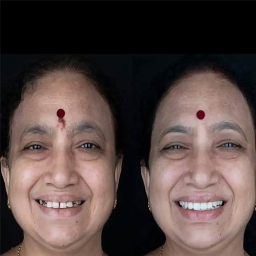 Smile Makeover 2