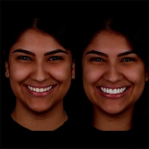 Smile Makeover 3