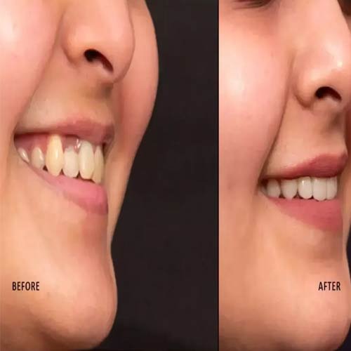 Smile Makeover 4