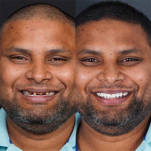 Smile Makeover 5