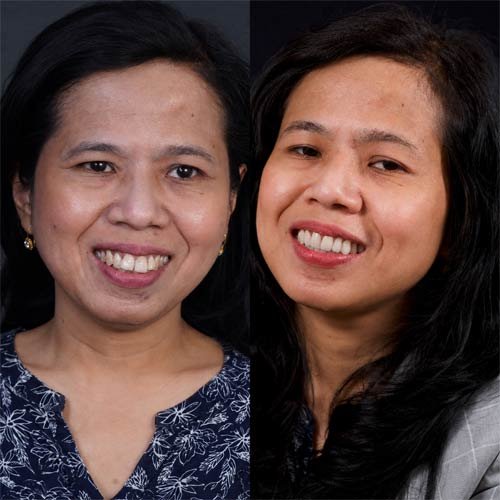 Smile Makeover 6