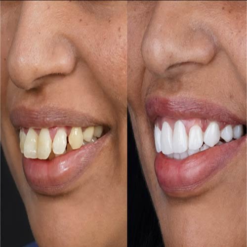 Smile Makeover 7