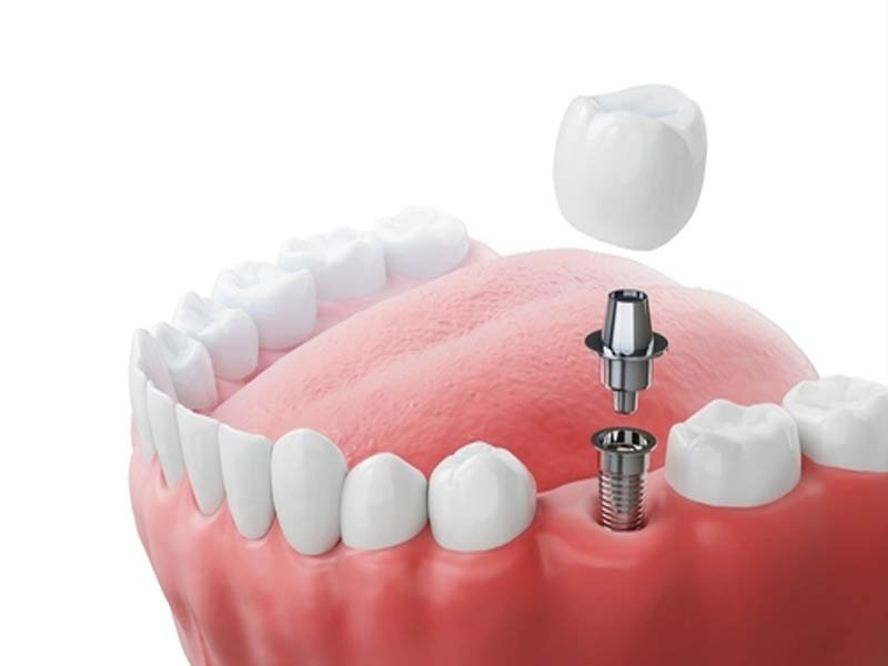 Dental Implant Diagram