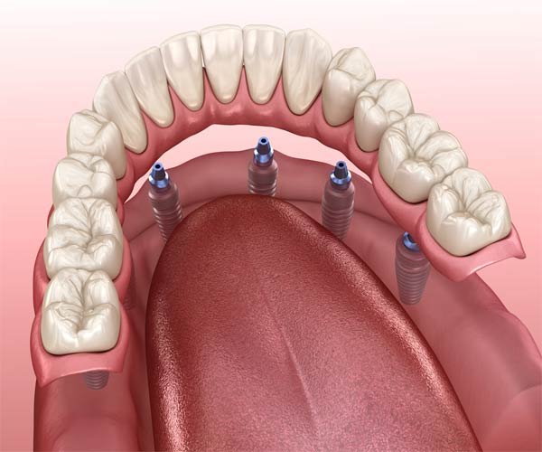 About Dental Implants
