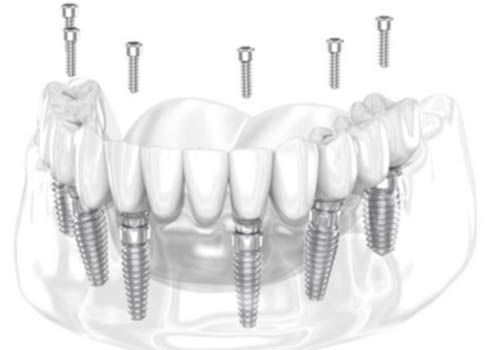 All-on-4 & All-on-6 Implants