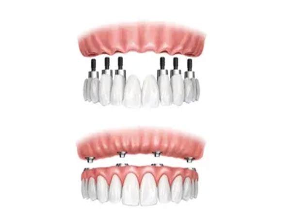 Implant-Supported Bridge