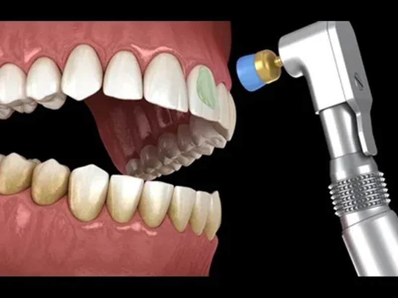 Advantages of Tooth Cleaning