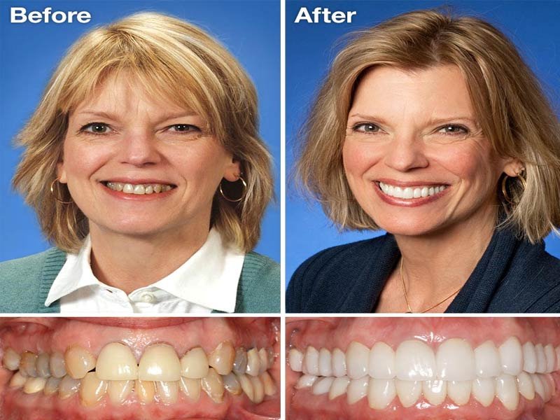 Dental Bonding