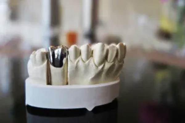 PFM (Porcelain-Fused-to-Metal) Crowns