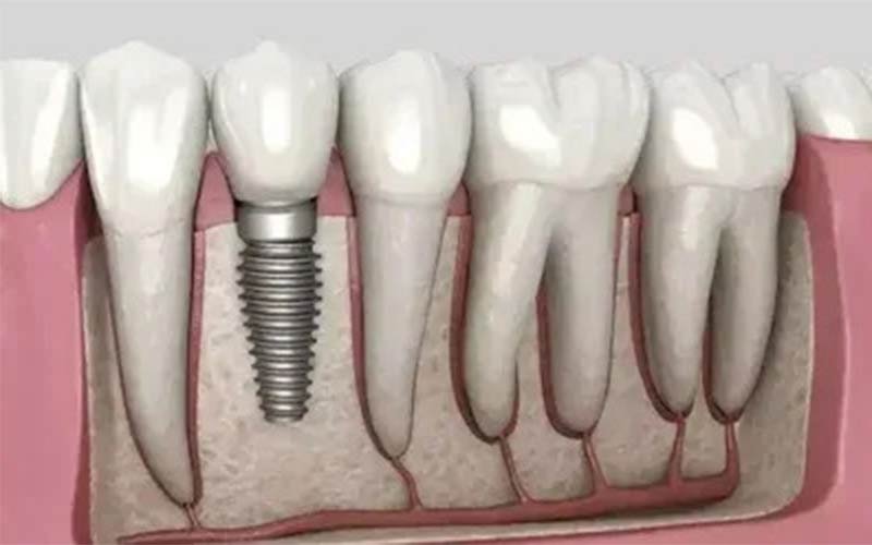 Dental Implants
