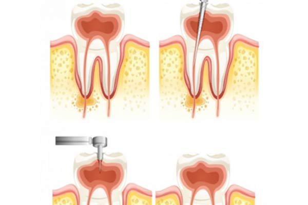 Microscopic Root Canal Treatment