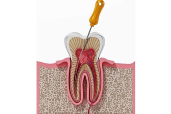 Root Canal Treatment (RCT)