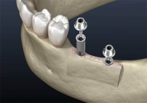 Endosteal Implants