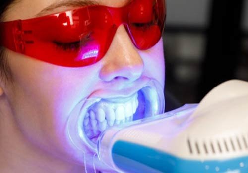 In-Office Professional Whitening