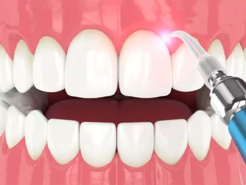 Laser Dentistry Advantages