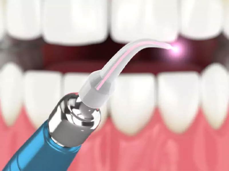 Laser Dental Procedure