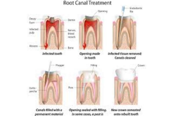 Conventional Root Canal