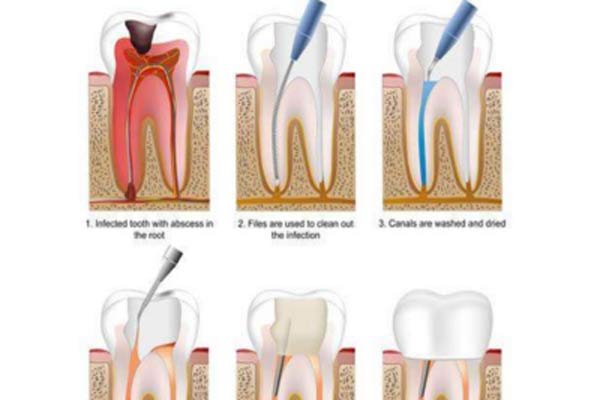 Painless Root Canal