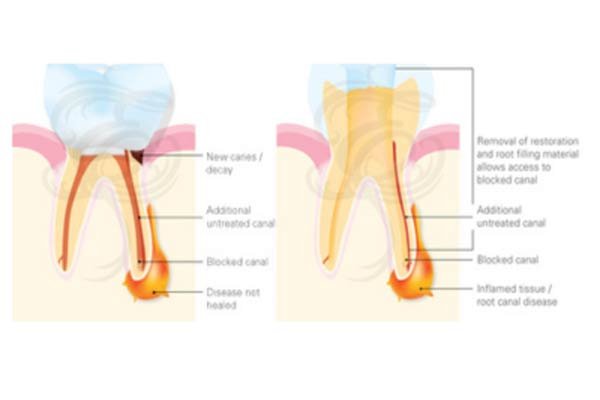 Re-Root Canal Treatment