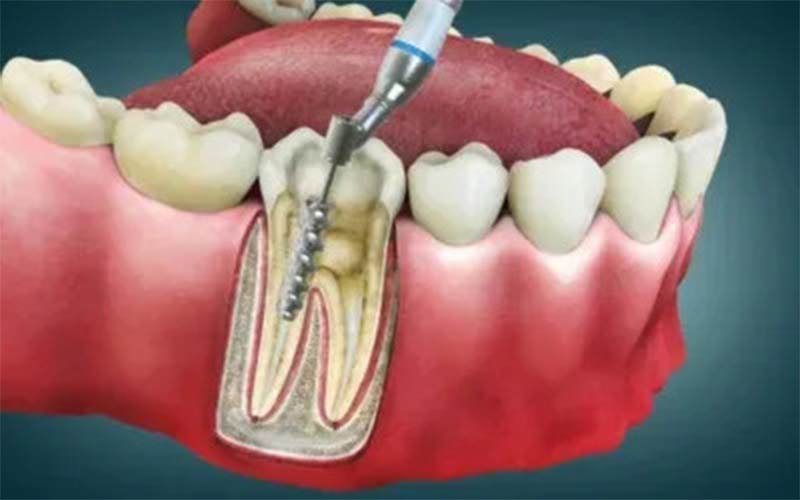Root Canal Treatment