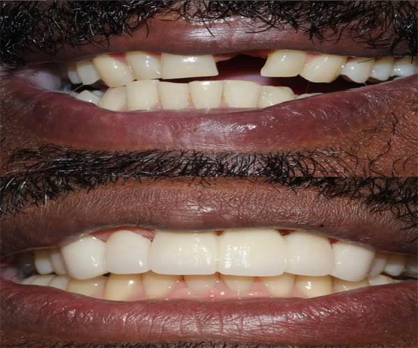 Single Tooth Implant