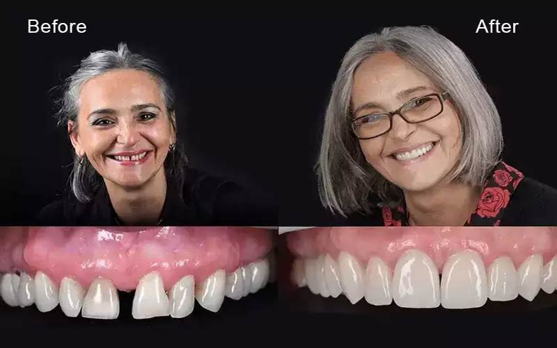 Smile Design