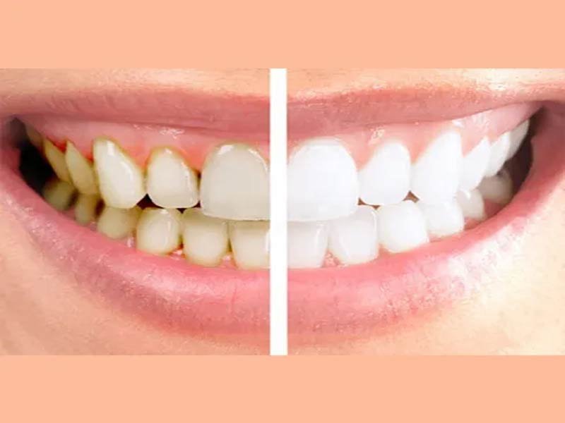 Tooth Polishing - Before and After