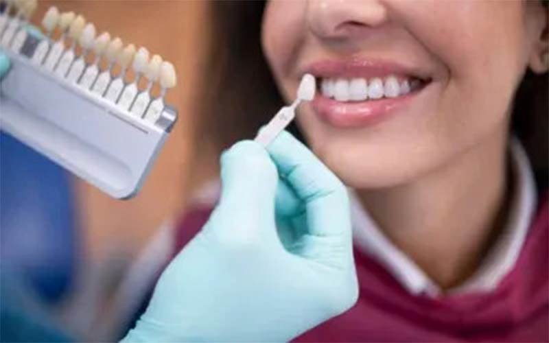 Veneers