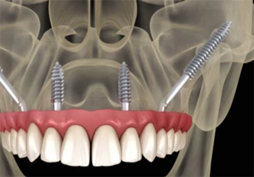 Zygomatic Implants