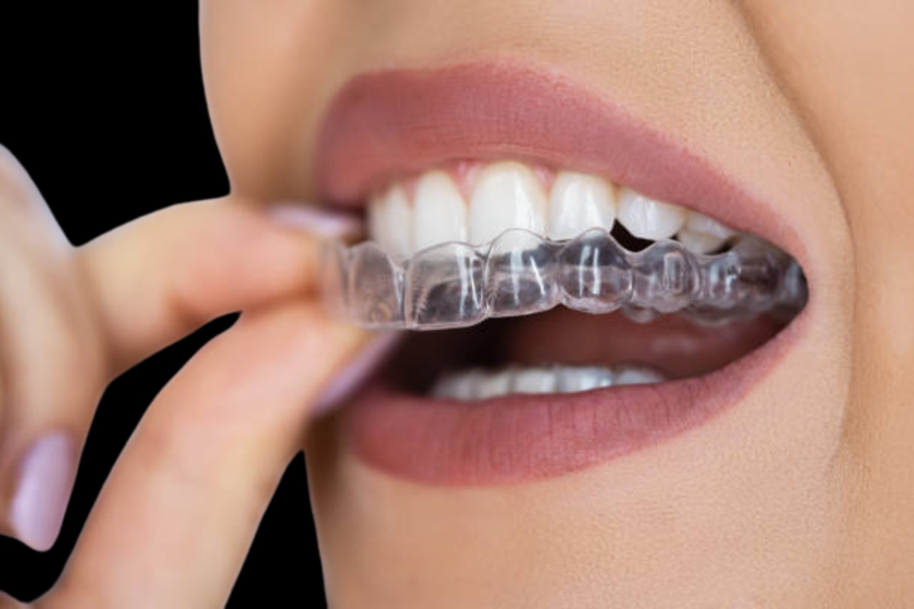 Aligners