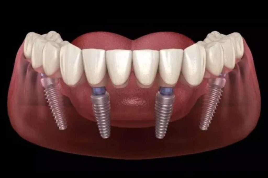 full mouth dental implants