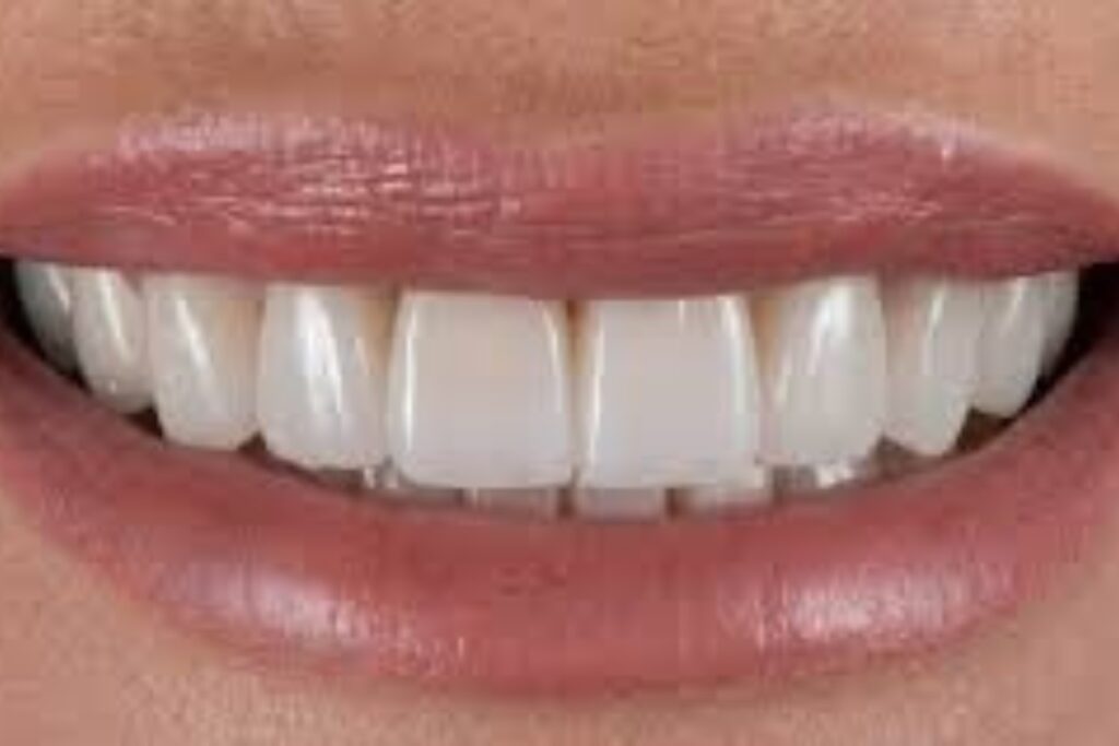 hollywood smile design