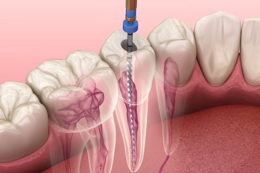 endodontic surgery