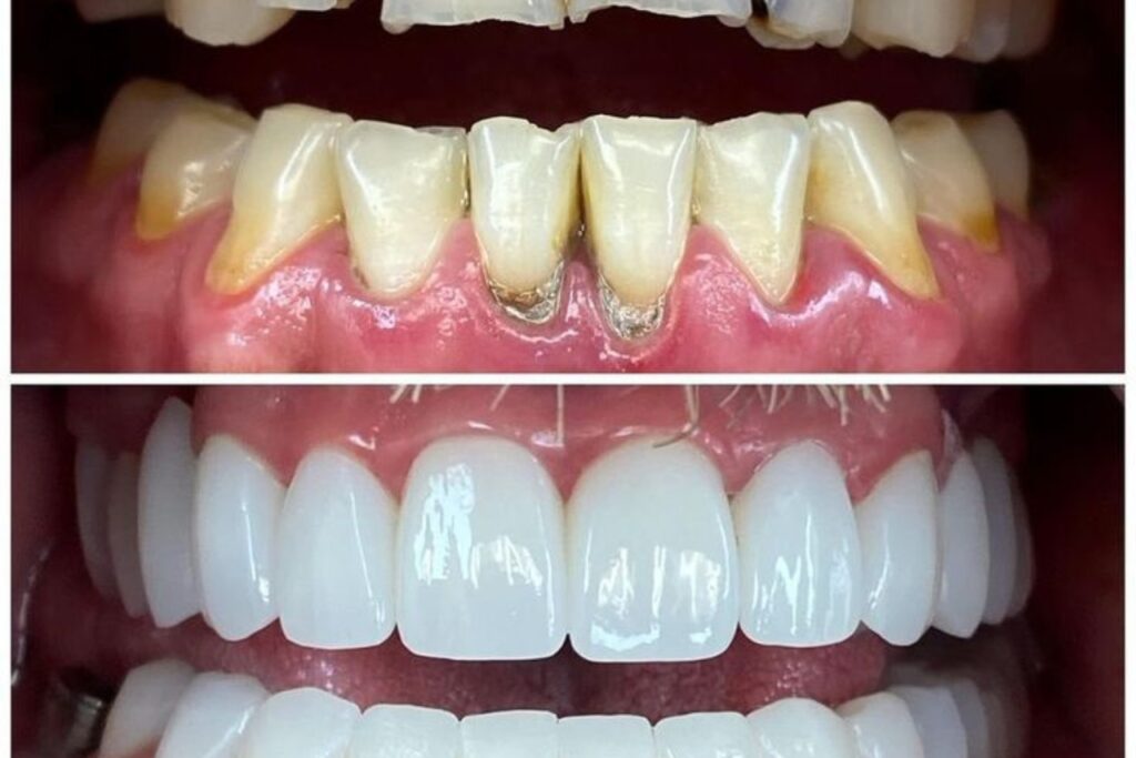 Root Canal Treatment